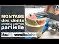 Montage des dents maxillomandibulaire  prothse amovible partielle  prothse dentaire  