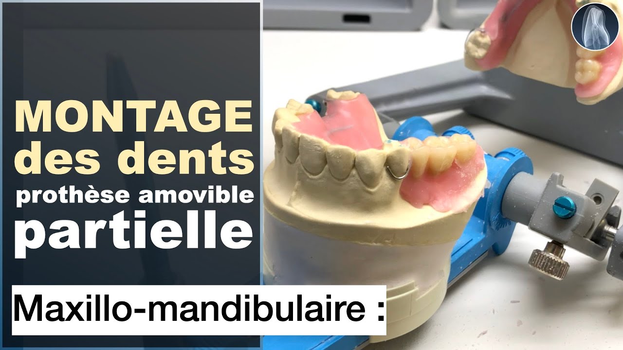 Montage des Dents sur Cire : Étapes Clés pour une Prothèse Amovible Partielle