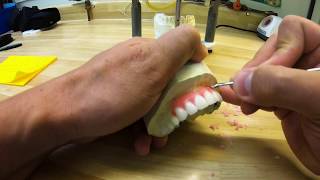 Immediate Partial Maxillary Setup