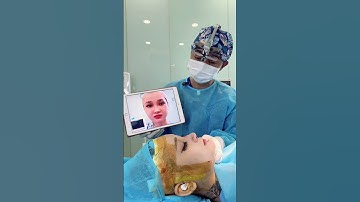 Từ mũi thấp tẹt đến dáng mũi cao tự nhiên – Ca nâng mũi bán cấu trúc tại Dr. Cơ