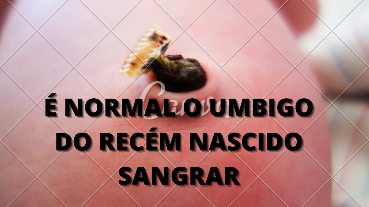 É NORMAL O UMBIGO DO RECÉM NASCIDO SANGRAR - YouTube