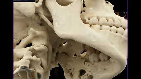 Amelioblastoma with Cinematic Rendering