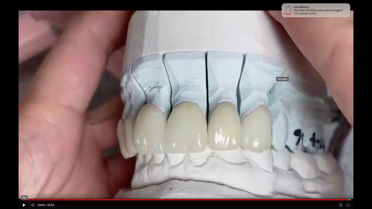 Veneers Simple Buildup Grind Glaze #6 #11