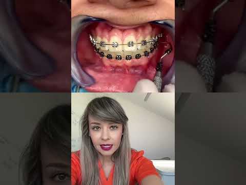 Video: Dolly avea aparat dentar în moonraker?