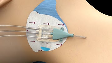 3M™ PICC/CVC Securement Dressing Application Video