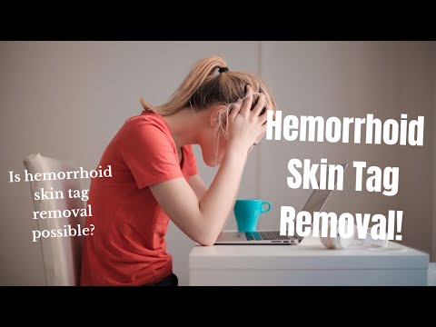 Vídeo: Anal Skin Tag: Causas, Remoção, Recuperação E Muito Mais