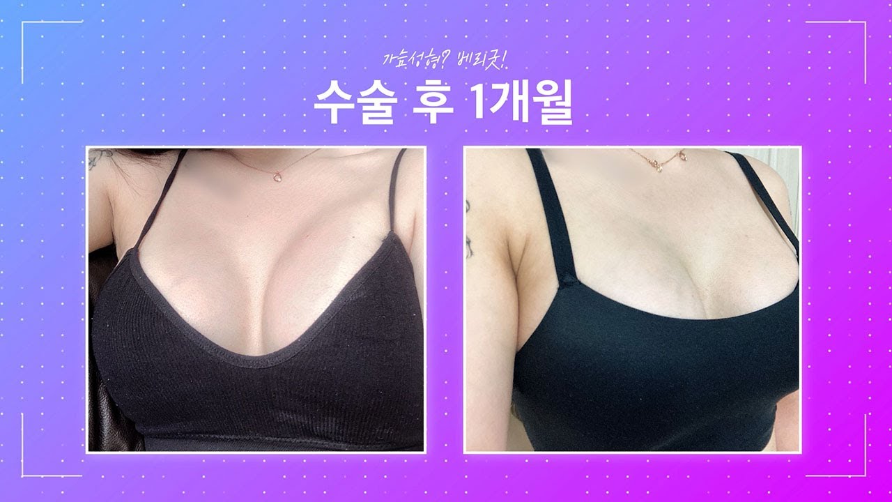 [Bệnh viện thẩm mỹ Verygood] #Bệnhviệnthẩm mỹVerygood Nâng ngực Verygood Video cảm giác ngực ✨PHẦN#2 Cảm giác mềm mại 😍 Bệnh viện thẩm mỹ Verygood