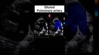 Pulmonary Artery Dilatation on Echo | Causes and Echocardiographic Clues  #2decho #echoeducation