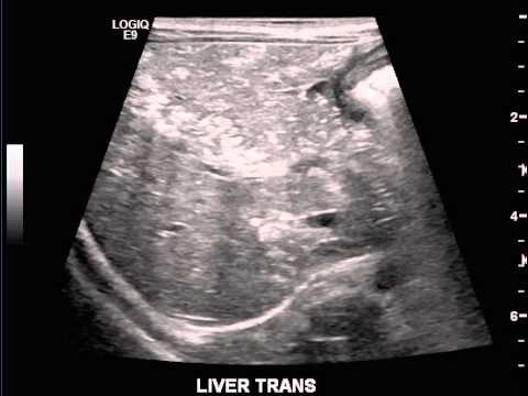 Portal Venous Gas by Ultrasound