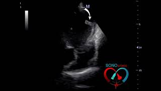 Left ventricular thrombi