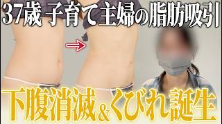 【お腹&腰 脂肪吸引】子どもに腹を掴まれ決心…のサムネイル