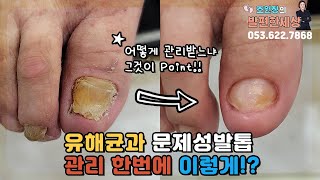 유해균, 문제성발톱 한번에 케어?? #대구내성발톱 #대구무좀 #문제성발 #fungal #toenails