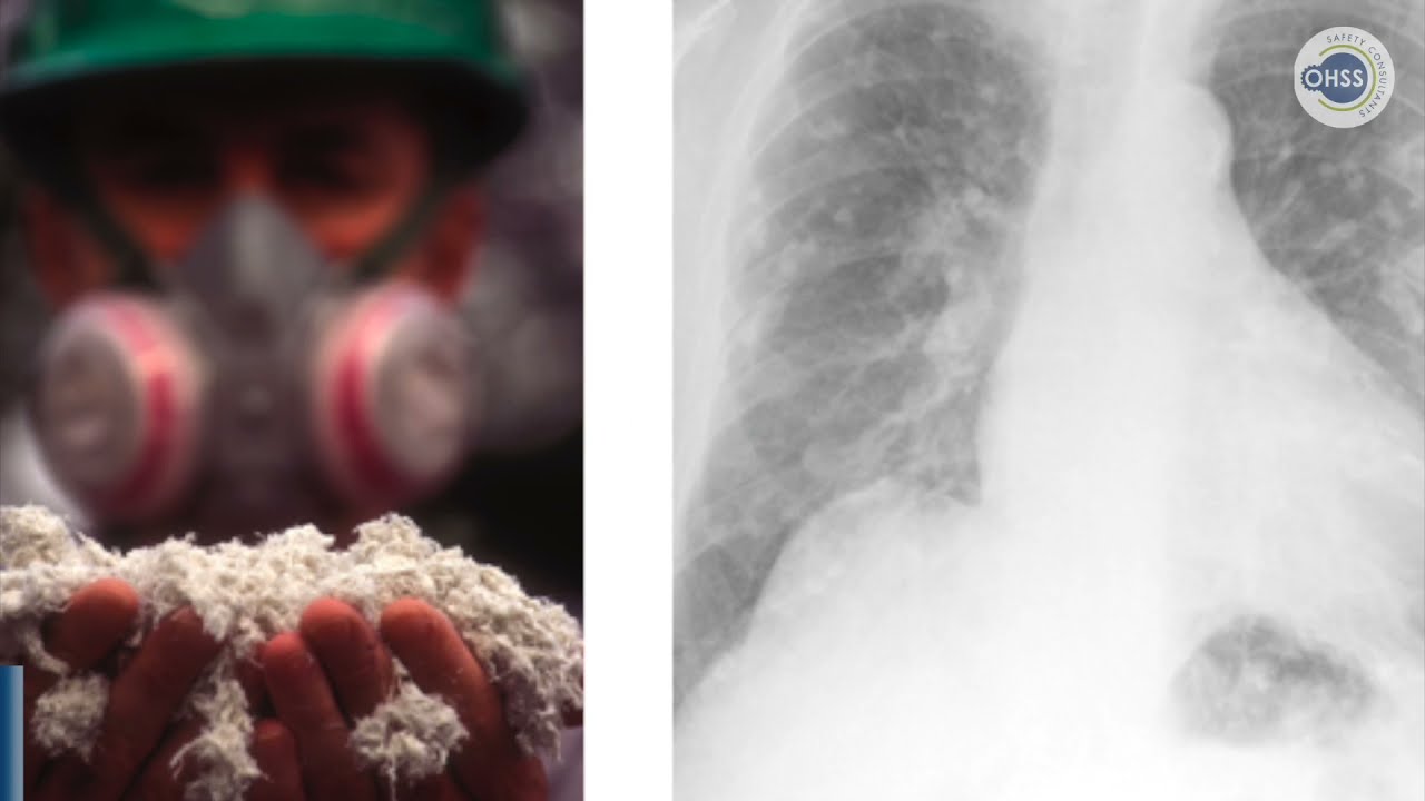 Asbestos: The Invisible Enemy that Hasn’t Gone Away from Ireland