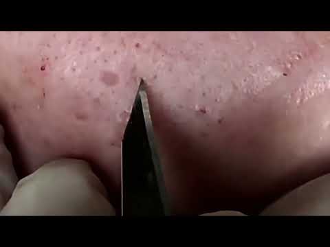 Acne, Blackheads, Pimples And Cystic Acne Removal On Face #