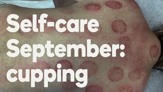 Self care September: Marisa tries cupping