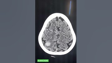 Hemorrhagic intracranial metastases - NCCT & MRI Brain - Basic Radiology