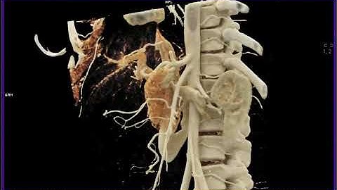 SMA and Left Renal Vein Relationship with Cinematic Rendering
