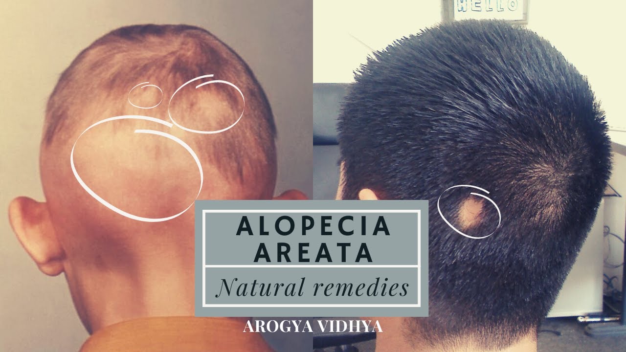Natural Remedies For ALOPECIA AREATA Fast Cure Arogya Vidhya YouTube natural-remedies-for-alopecia-areata-fast-cure-arogya-vidhya-youtube