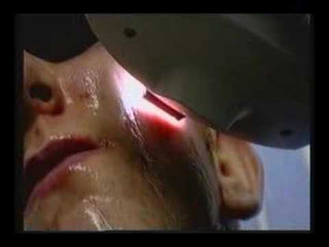 Blue light lasers and acne: RTE TV interview Dr. Treacy