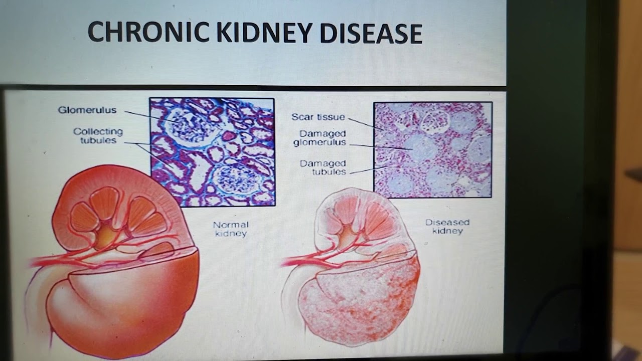 clinical presentation of kidney disease