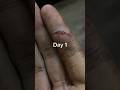 30 Days Nasty Finger Cut Wounds Healing Time Lapse 