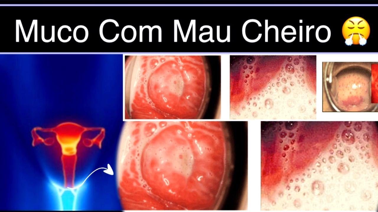 Como Acabar Com Mau Cheiro na Vagin Acompanhado com corrimento branco ...
