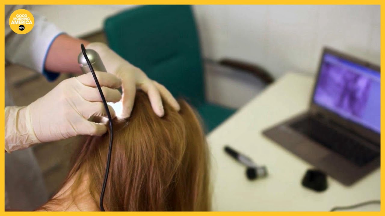 'From Thinning to Winning' looks at baldness breakthrough