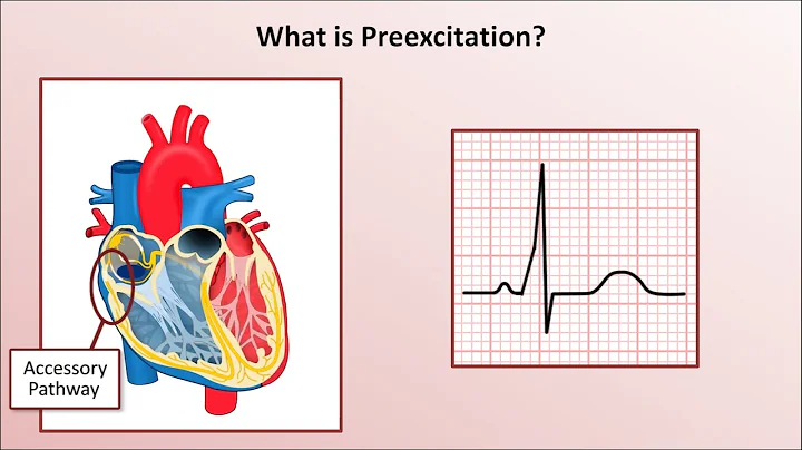 Advanced EKGs - Wolff-Parkinson-White (WPW) Syndrome
