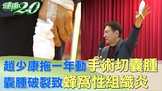 拖一年動手術切'囊腫' 趙少康:'開個冰箱'搞成這樣 健康2.0@tvbshealth20 by 健康2.0 350 views 2 hours ago 14 minutes, 48 seconds