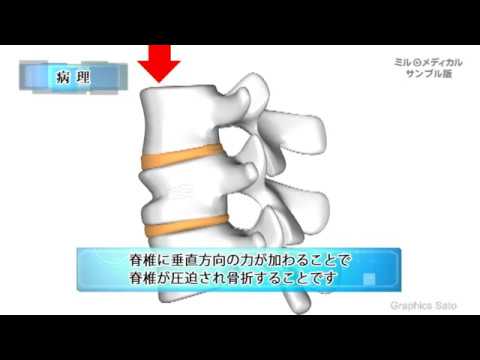 胸椎 圧迫 骨折 コルセット 期間