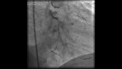 Complex PCI for RCA CTO with bifurcation at distal cap video 12