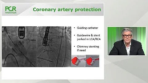 TAVI and coronary access risk management - PCR Webinar