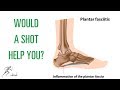 Should you get a cortisone shot for plantar fasciitis?