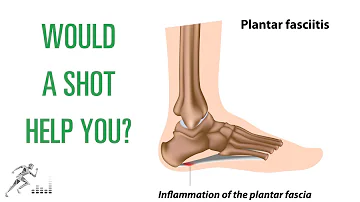 How long does it take for a cortisone shot to work for plantar fasciitis?