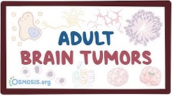 Adult brain tumors - causes, symptoms, diagnosis, treatment, pathology