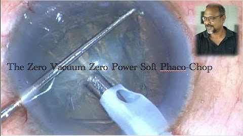 The zero vacuum - zero power - Phaco Chop in soft cataracts