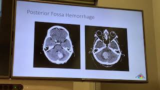 Approach to Vertigo and the HiNTs Exam - Neurology Rounds Clerkship Series, Part 2