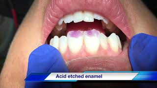 how to do quick fix chipped teeth