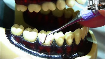 S204S Posterior Sickle Scaler