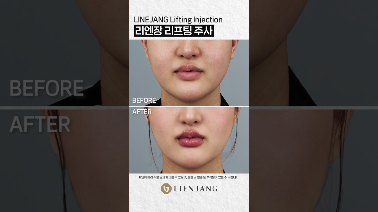 Риенжанг Гоо Сайхны Мэс Заслын Эмнэлэг: Лифтинг #богино_бичлэг