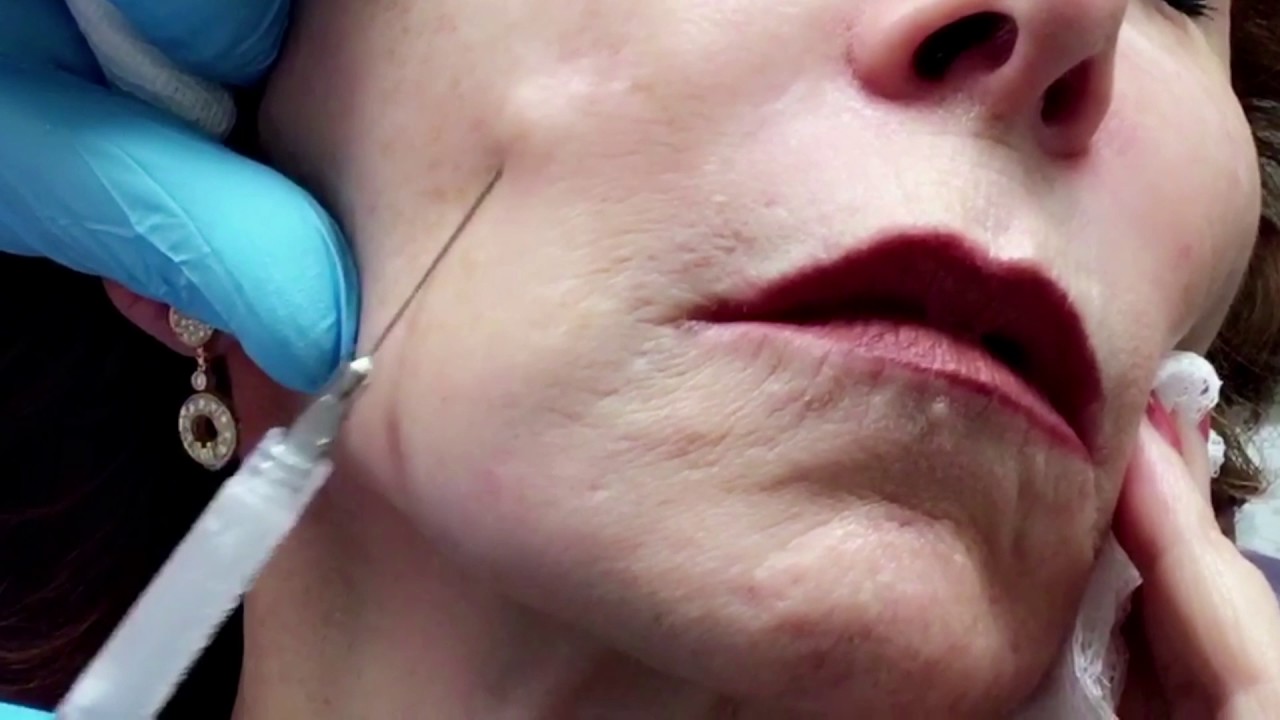 Sculptra in the office with Dr Onir