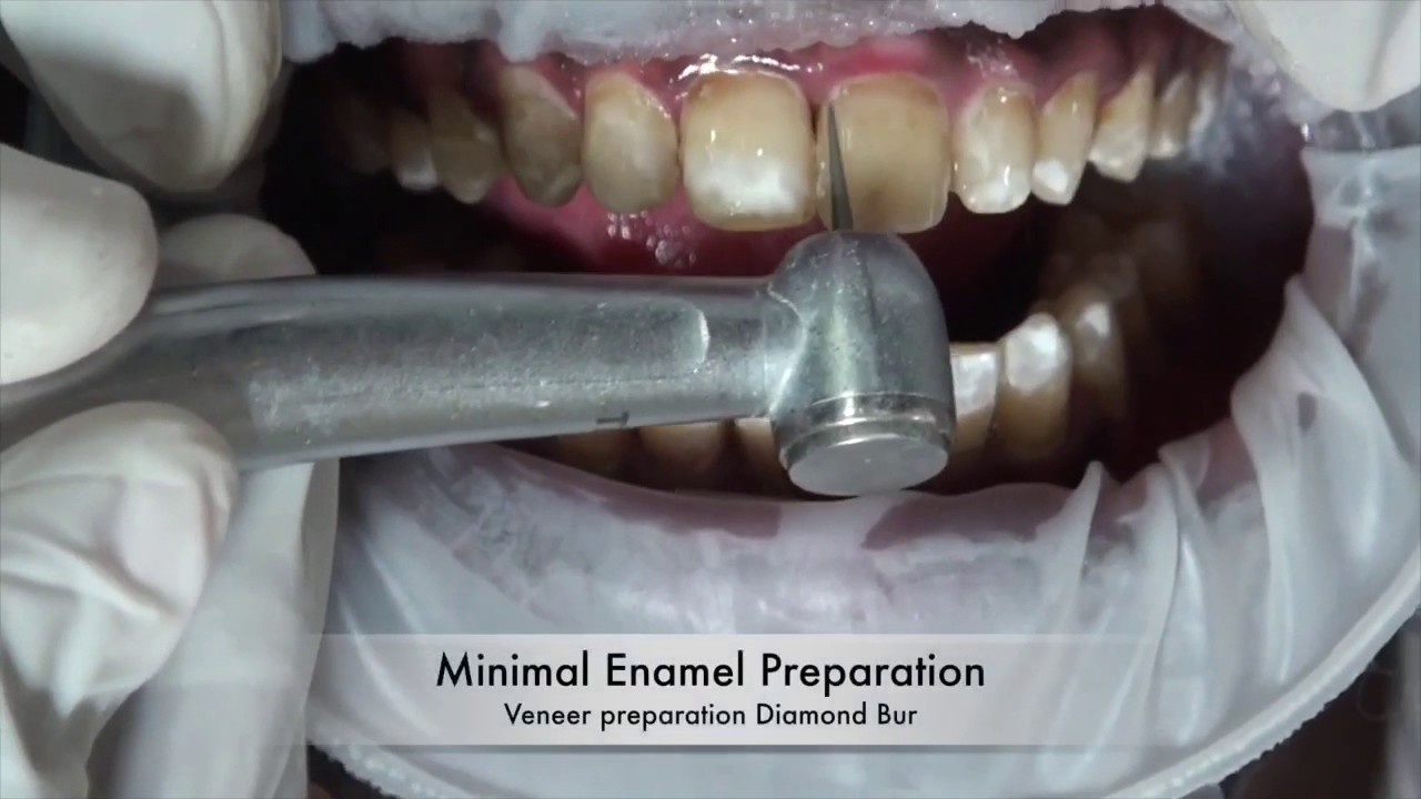 Direct composite veneering - Single sitting smile enhancement 2