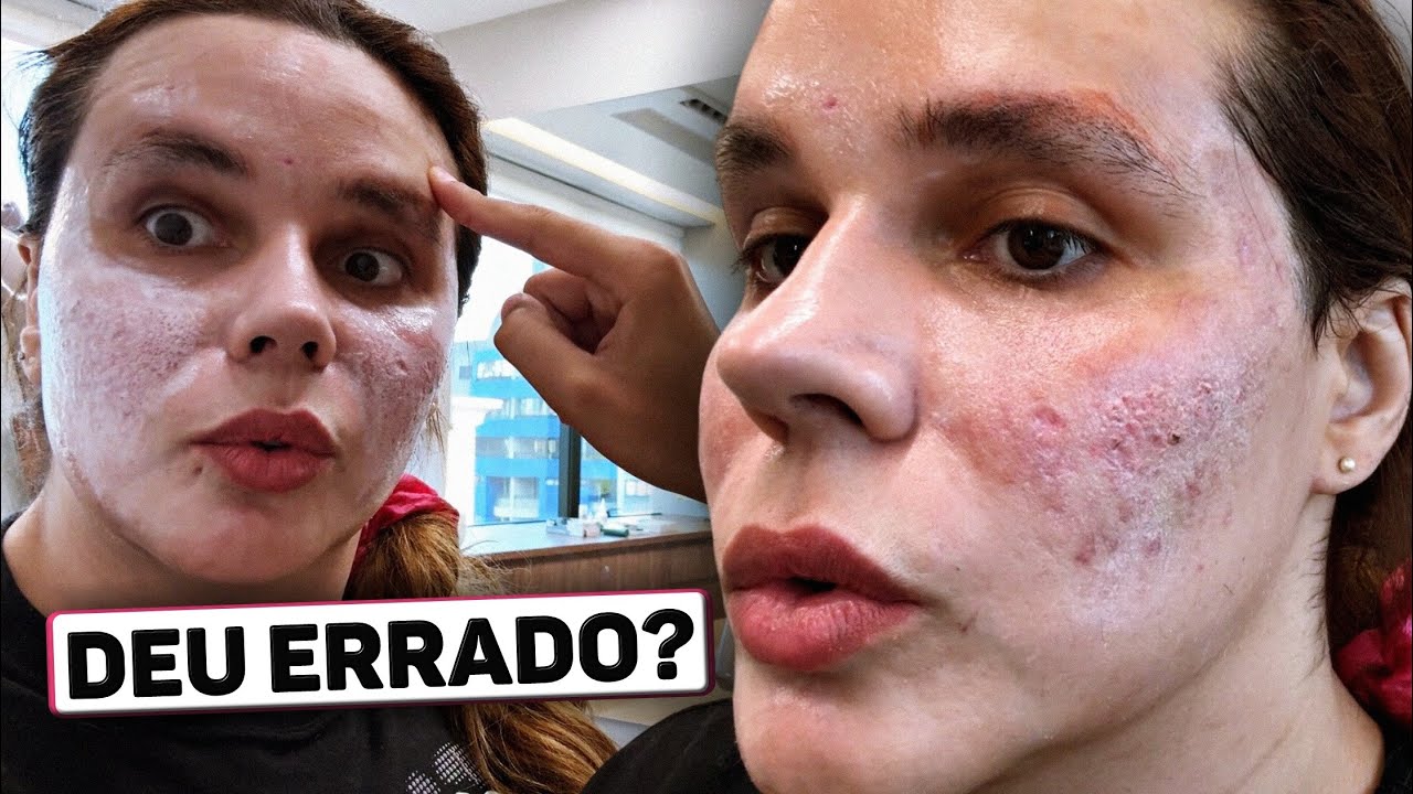 DEU ERRADO meu PEELING DE ATA?