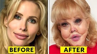 49 Celebrity Plastic Surgery Disasters | Then and Now