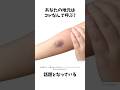 知ってた?全国でこんなに違う&ldquo;青あざ&rdquo;の呼び方 #方言 #青あざ
