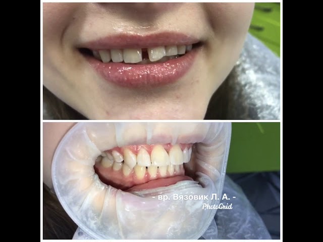 Закрытие диастемы (щели между передними зубами) - стоматолог Харьков