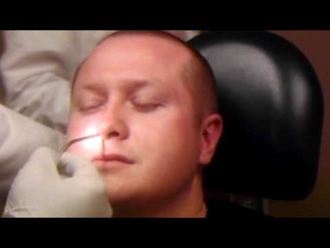 Removal of Septoplasty Nasal Tube Splints - YouTube