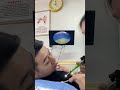 耳垢そうじ/耳が痒くなった鼓膜に付着した軟耳垢/ #shorts