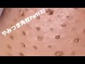 【acne pimple】やみつき角栓Part133