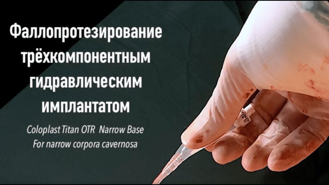 Фаллопротезирование В Москве Цены Отзывы И Фото – Telegraph